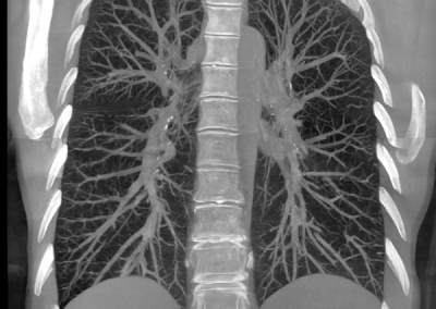 Lung Imaging