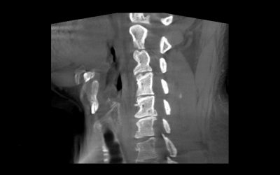SeeFactor CT3 – Let’s Consider Cranial and Spine